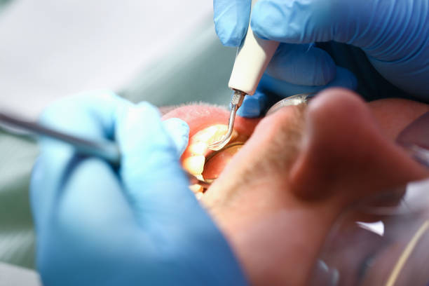 Best Emergency Tooth Extraction in Newark, DE