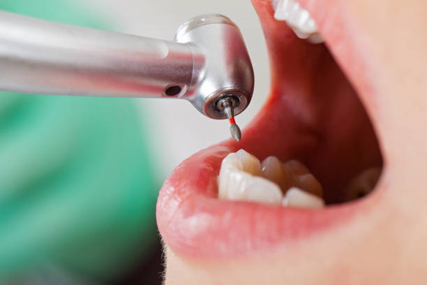 Best Emergency Wisdom Teeth Removal in Newark, DE